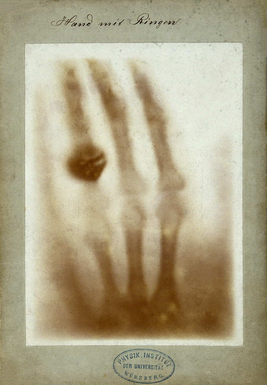 The first medical X-ray, the bones of Anna Bertha Ludwig&rsquo;s hand with her wedding ring, 1895